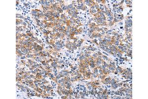Immunohistochemistry of Human breast cancer using CLDN3 Polyclonal Antibody at dilution of 1:25 (Claudin 3 抗体)