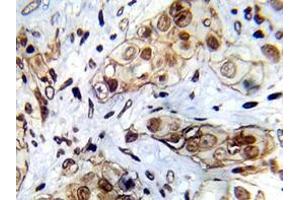 Immunohistochemistry analyzes of Abl1 antibody in paraffin-embedded human breast carcinoma tissue. (ABL1 抗体)