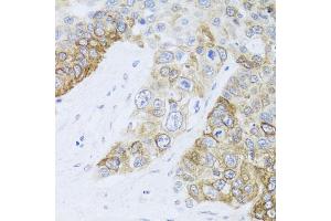 Immunohistochemistry of paraffin-embedded human lung cancer using CHD1 antibody. (CHD1 抗体)