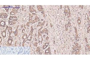 Immunohistochemistry of paraffin-embedded Human liver cancer tissue using CD5 Monoclonal Antibody at dilution of 1:200. (CD5 抗体)