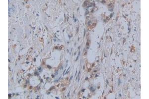 DAB staining on IHC-P; Samples: Human Pancreatic cancer Tissue (CCL2 抗体  (AA 24-99))