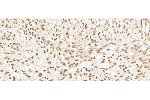 Immunohistochemistry of paraffin-embedded Human liver cancer tissue using GTF2A2 Polyclonal Antibody at dilution of 1:30(x200) (GTF2A2 抗体)