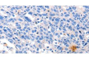 Immunohistochemistry of paraffin-embedded Human ovarian cancer tissue using GRIN2D Polyclonal Antibody at dilution 1:30 (GRIN2D 抗体)