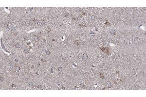 ABIN6276561 at 1/100 staining Human brain cancer tissue by IHC-P. (BCL2L2 抗体  (N-Term))