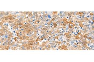 Immunohistochemistry of paraffin-embedded Human cervical cancer tissue using FANCB Polyclonal Antibody at dilution of 1:60(x200) (FANCB 抗体)
