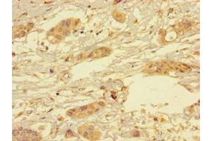 Immunohistochemistry of paraffin-embedded human pancreatic cancer using ABIN7166350 at dilution of 1:100 (YIPF6 抗体  (AA 2-84))