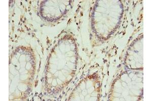 Immunohistochemistry of paraffin-embedded human colon cancer using ABIN7142648 at dilution of 1:100 (NSUN4 抗体  (AA 26-284))