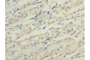 Immunohistochemistry of paraffin-embedded human gastric cancer using ABIN7173199 at dilution of 1:100 (TMEM31 抗体  (AA 1-118))