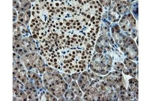 Immunohistochemical staining of paraffin-embedded Adenocarcinoma of colon tissue using anti-RC211175 mouse monoclonal antibody. (TUBA8 抗体)
