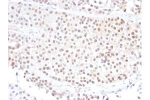 Formalin-fixed, paraffin-embedded human Bladder Carcinoma stained with p21 Mouse Monoclonal Antibody (DCS-60. (p21 抗体)