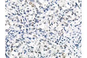 Phospho-RAD18 (Ser99) Antibody at 1/100 staining Human breast cancer by IHC-P. (RAD18 抗体  (pSer99))