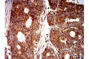 Immunohistochemical analysis of paraffin-embedded rectum cancer tissues using EIF5 mouse mAb with DAB staining. (EIF5 抗体  (AA 1-300))