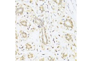 Immunohistochemistry of paraffin-embedded human mammary cancer using STAT1 antibody. (STAT1 抗体  (AA 650-750))