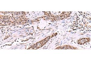 Immunohistochemistry of paraffin-embedded Human esophagus cancer tissue using CUL4A Polyclonal Antibody at dilution of 1:55(x200) (Cullin 4A 抗体)