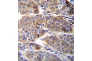 Immunohistochemistry analysis in formalin fixed and paraffin embedded human melanoma reacted with PLA2G2C Antibody (C-term) followed which was peroxidase conjugated to the secondary antibody and followed by DAB staining. (PLA2G2C 抗体  (C-Term))