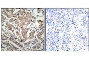 Immunohistochemical analysis of paraffin-embedded human breast carcinoma tissue using BAD (Ab-155) antibody (E021064). (BAD 抗体)