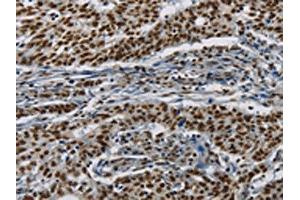 The image on the left is immunohistochemistry of paraffin-embedded Human gastic cancer tissue using ABIN7190953(HIST1H2AB Antibody) at dilution 1/20, on the right is treated with synthetic peptide. (HIST1H2AB 抗体)