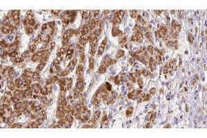 ABIN6278185 at 1/100 staining Human liver cancer tissue by IHC-P. (PNPLA2 抗体  (Internal Region))