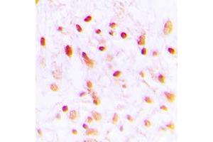 Immunohistochemical analysis of CTBP1 staining in human lung cancer formalin fixed paraffin embedded tissue section. (CTBP1 抗体  (C-Term))
