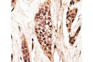 IHC analysis of FFPE human breast carcinoma tissue stained with the TAP1 antibody (TAP1 抗体  (AA 765-794))