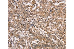 Immunohistochemistry of Human liver cancer using KCNG2 Polyclonal Antibody at dilution of 1:40 (Kcng2 抗体)