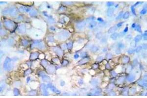 Immunohistochemistry (IHC) analyzes of p-HSP27 antibody in paraffin-embedded human breast carcinoma tissue. (HSP27 抗体  (pSer78, pSer82))