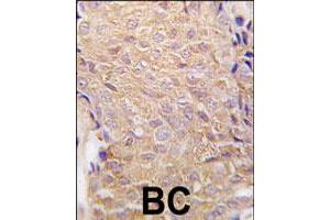 Formalin-fixed and paraffin-embedded human breast carcinoma tissue reacted with ALDH6A1 polyclonal antibody  , which was peroxidase-conjugated to the secondary antibody, followed by DAB staining. (ALDH6A1 抗体  (N-Term))