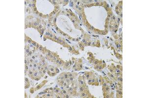 Immunohistochemistry of paraffin-embedded human thyroid cancer using NCF4 Antibody (ABIN5971122) at dilution of 1/100 (40x lens). (NCF4 抗体)
