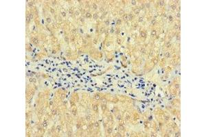 Immunohistochemistry of paraffin-embedded human liver cancer using ABIN7163173 at dilution of 1:100 (TPTE2 抗体  (AA 167-411))