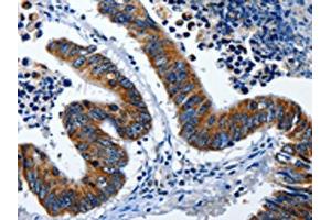 The image on the left is immunohistochemistry of paraffin-embedded Human colon cancer tissue using ABIN7191255(LAMA1 Antibody) at dilution 1/25, on the right is treated with synthetic peptide. (Laminin alpha 1 抗体)