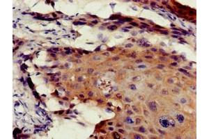 Immunohistochemistry of paraffin-embedded human cervical cancer using ABIN7172545 at dilution of 1:100 (ETV7 抗体  (AA 134-218))