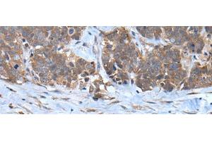 Immunohistochemistry of paraffin-embedded Human thyroid cancer tissue using CNTN1 Polyclonal Antibody at dilution of 1:35(x200) (Contactin 1 抗体)
