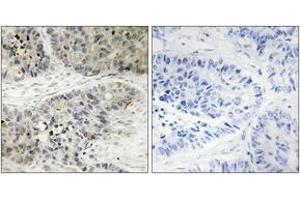 Immunohistochemistry analysis of paraffin-embedded human lung carcinoma, using MAPK15 Antibody. (MAPK15 抗体  (AA 361-410))