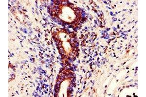 Immunohistochemistry of paraffin-embedded human prostate cancer using ABIN7150628 at dilution of 1:100 (STAU1/Staufen 抗体  (AA 163-403))