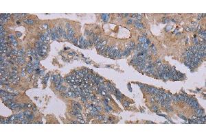 Immunohistochemistry of paraffin-embedded Human colon cancer using MMP20 Polyclonal Antibody at dilution of 1:40 (MMP20 抗体)