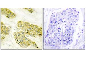 Immunohistochemistry analysis of paraffin-embedded human breast carcinoma tissue using COL5A3 antibody. (COL5A3 抗体  (N-Term))