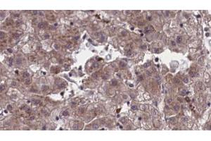 ABIN6273956 at 1/100 staining Human liver cancer tissue by IHC-P.