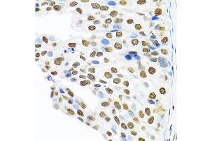 Immunohistochemistry of paraffin-embedded human prostate cancer using PTBP1 antibody at dilution of 1:100 (40x lens). (PTBP1 抗体)
