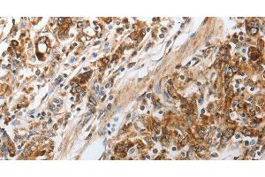 Immunohistochemistry of paraffin-embedded Human gastic cancer using NPY1R Polyclonal Antibody at dilution of 1:30 (NPY1R 抗体)