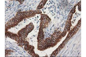 Immunohistochemical staining of paraffin-embedded Adenocarcinoma of Human colon tissue using anti-TUBB4 mouse monoclonal antibody. (TUBB4 抗体)