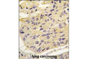 Formalin-fixed and paraffin-embedded human lung carcinoma tissue reacted with FRAT1 antibody , which was peroxidase-conjugated to the secondary antibody, followed by DAB staining.