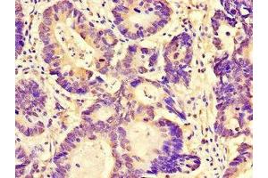 Immunohistochemistry of paraffin-embedded human colon cancer using ABIN7165414 at dilution of 1:100 (FAM151B 抗体  (AA 1-276))