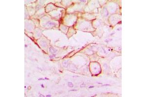Immunohistochemical analysis of RNF144A staining in human breast cancer formalin fixed paraffin embedded tissue section. (RNF144A 抗体  (Center))