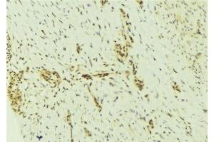 ABIN6276929 at 1/100 staining Human breast cancer tissue by IHC-P. (DKC1 抗体  (Internal Region))