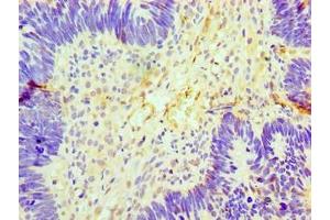 Immunohistochemistry of paraffin-embedded human ovarian cancer using ABIN7153892 at dilution of 1:100 (GCKR 抗体  (AA 1-625))