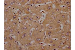 IHC image of ABIN7139992 diluted at 1:200 and staining in paraffin-embedded human liver cancer performed on a Leica BondTM system. (OR4C15 抗体  (AA 258-268))