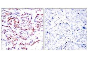 Immunohistochemical analysis of paraffin-embedded human breast carcinoma tissue using ATF2(Phospho-Ser112 or 94) Antibody(left) or the same antibody preincubated with blocking peptide(right). (ATF2 抗体  (pSer112))