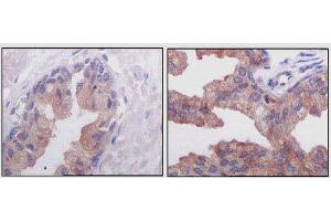 Immunohistochemical analysis of paraffin-embedded human normal prostate tissues (left) and prostate adenocarcinoma tissues (right), showing cytoplasmic localization using AMACR mouse mAb with DAB staining. (AMACR 抗体)