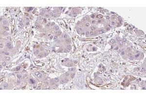 ABIN6273934 at 1/100 staining Human liver cancer tissue by IHC-P. (GPR33 抗体  (Internal Region))