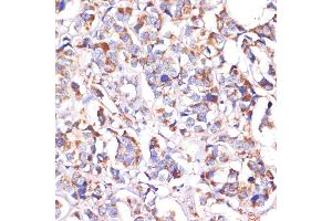Immunohistochemistry of paraffin-embedded human breast cancer using STOML2 antibody (ABIN6132693, ABIN6148629, ABIN6148630 and ABIN6214642) at dilution of 1:100 (40x lens). (STOML2 抗体  (AA 29-356))